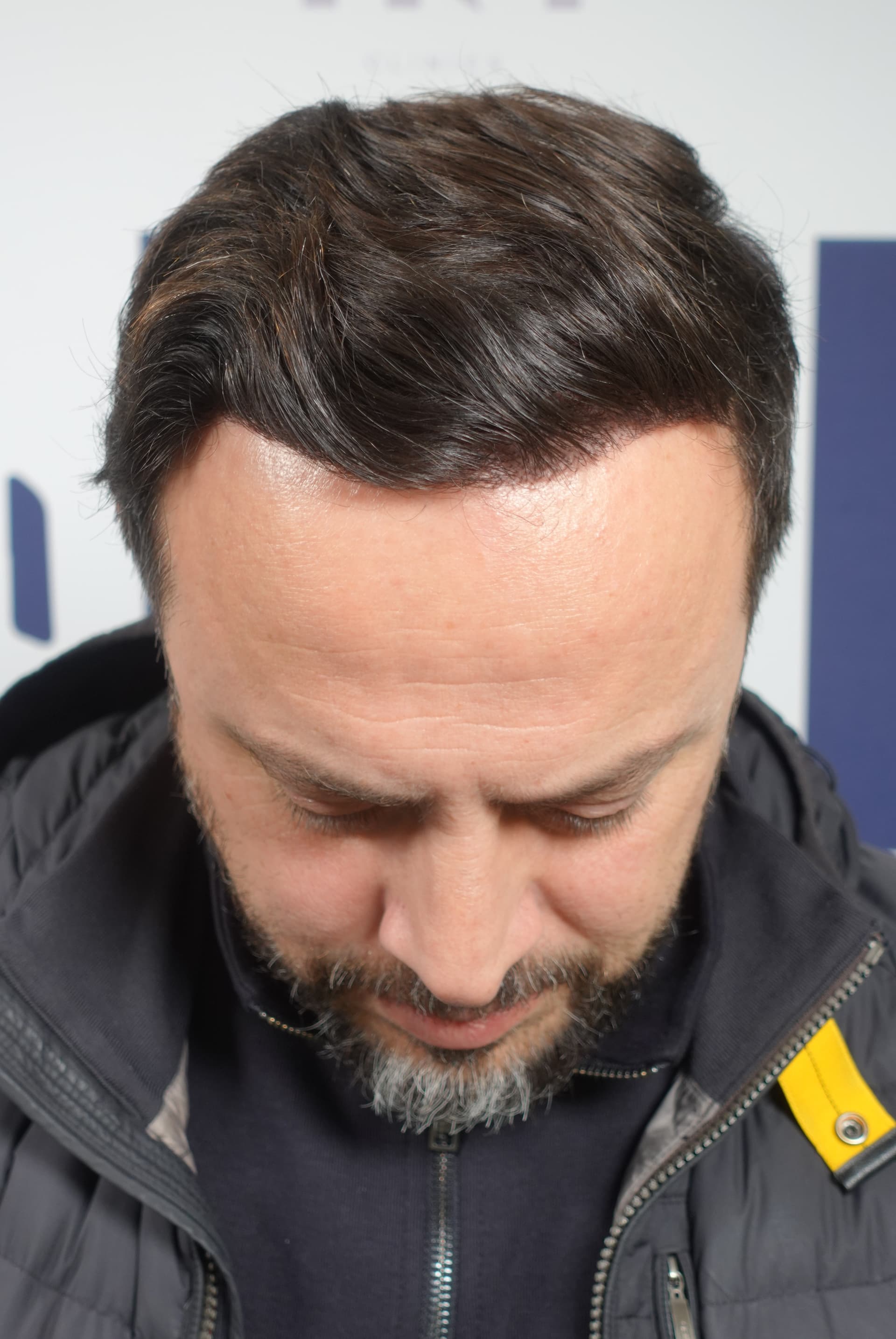 Haartransplantatie resultaat na behandeling - 4