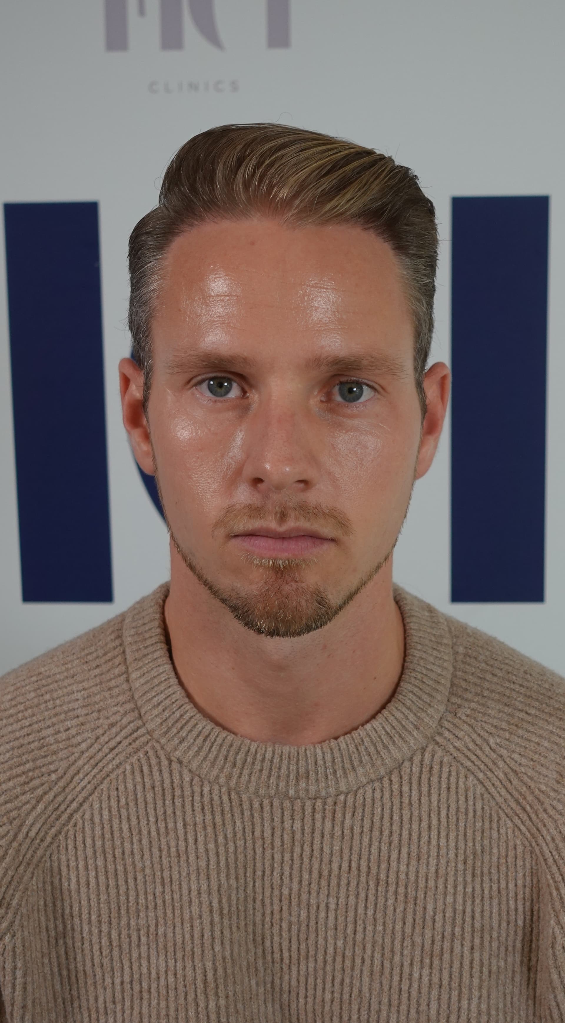 Haartransplantatie resultaat na behandeling - 5