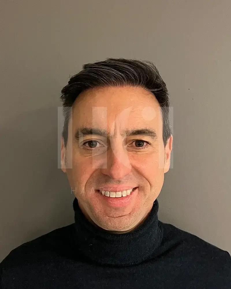 Haartransplantatie resultaat na behandeling - 1