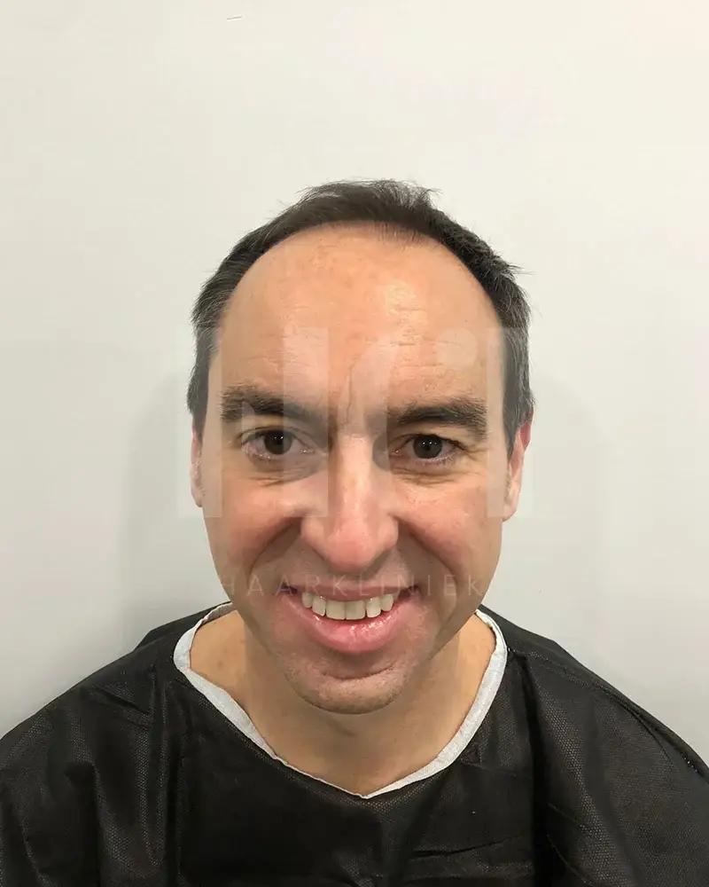 Haartransplantatie resultaat voor behandeling - 1