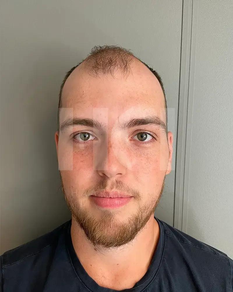 Haartransplantatie resultaat voor behandeling - 2