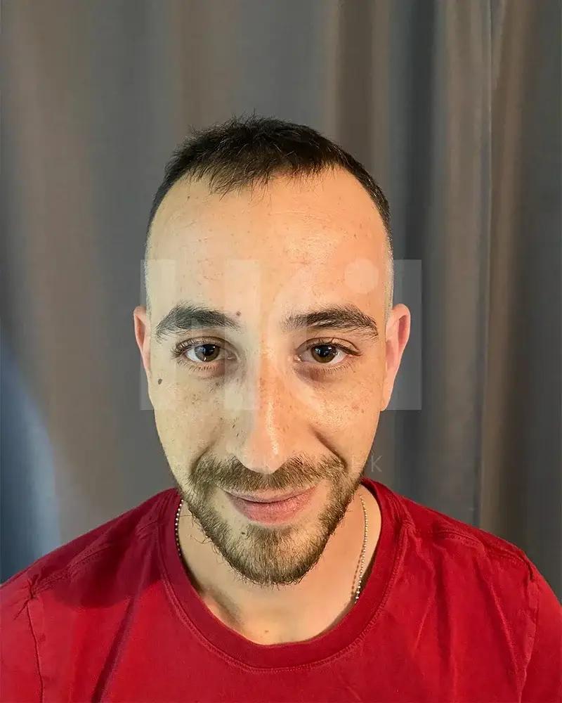 Haartransplantatie resultaat voor behandeling - 3