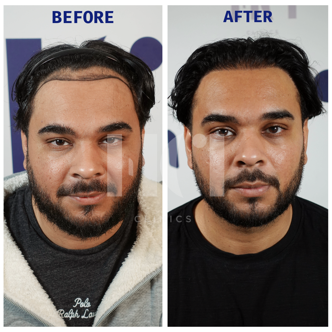 Before / After