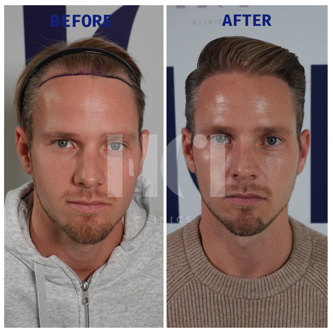 Before / After