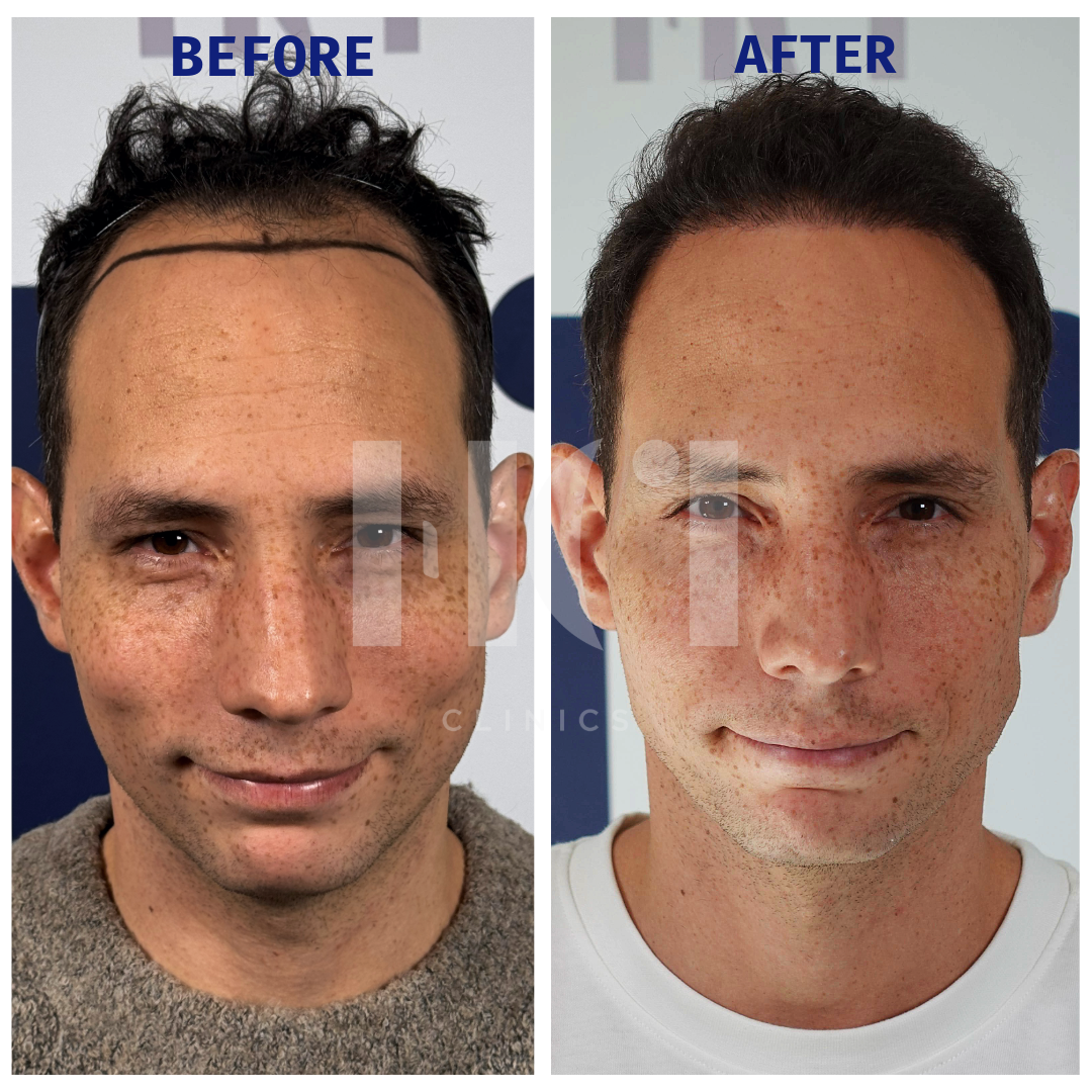 Before / After