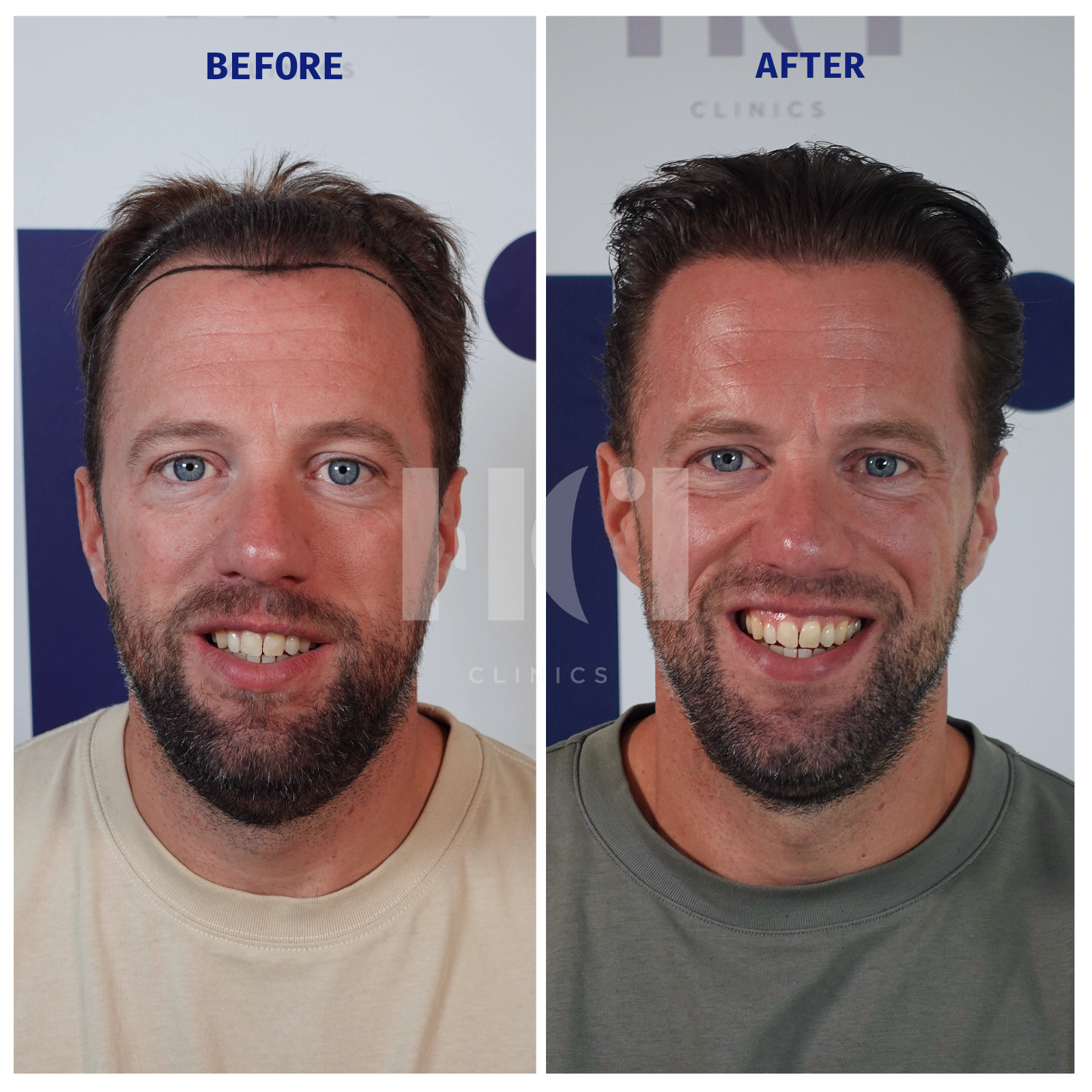 Before / After